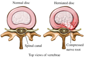 Cervical Myelopathy