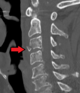 3 Common Spine Injuries Following a Motor Vehicle Accident