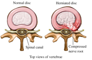 3 Common Spine Injuries Following a Motor Vehicle Accident