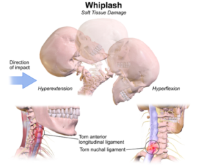 3 Common Spine Injuries Following a Motor Vehicle Accident