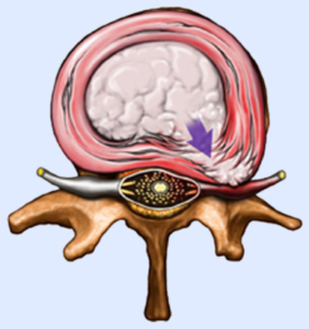 How a Herniated Disc Causes Pain in the Extremities