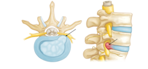 Everything You Wanted to Know About Minimally Invasive Spine Surgery