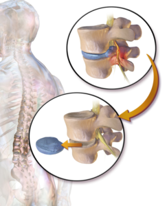 3 Spine Surgeries That Are Now Minimally Invasive