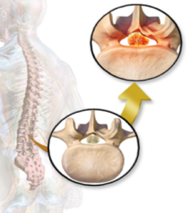 What Decompressing a Spinal Nerve Means