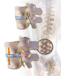 What Decompressing a Spinal Nerve Means